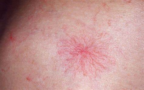 肝硬化出现蜘蛛痣是什么原因,肝硬化有蜘蛛痣的概率有多大