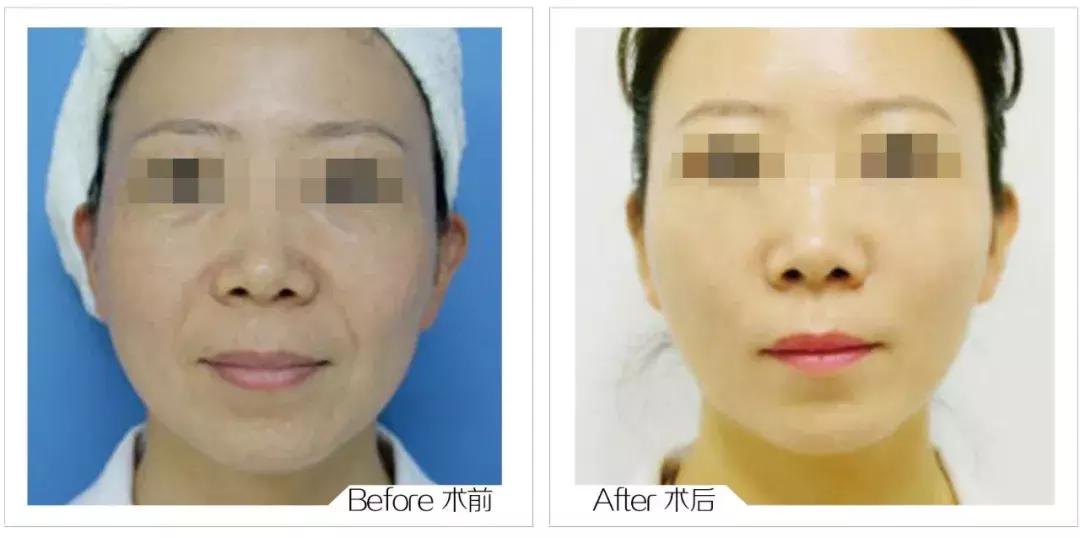 线雕加玻尿酸可以保多长时间,玻尿酸加线雕隆鼻能半永久吗