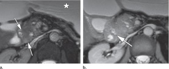 急性胰腺炎和慢性胰腺有什么症状,胰腺炎合并胰腺肿物