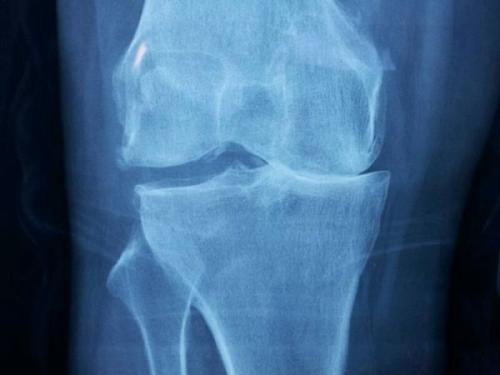 o型腿很难矫正吗,膝关节炎导致o型腿的原因