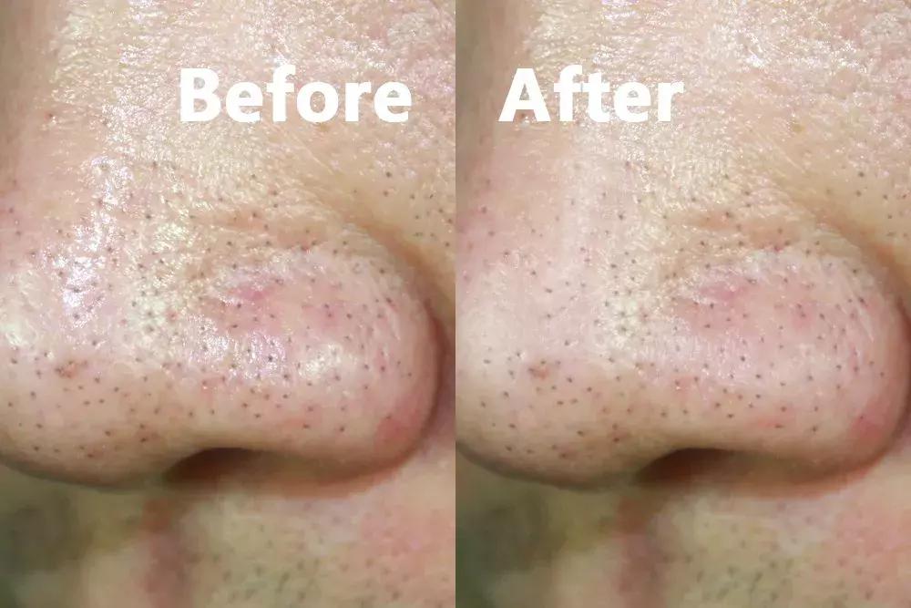 怎么正确用凡士林去黑头,凡士林去黑头修复怎么用