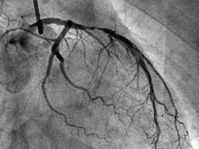 心脏病中度狭窄不做手术能活多久,心脏血管狭窄85%吃中药能治好吗