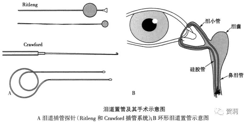 泪道狭窄和阻塞的相关知识,泪道狭窄阻塞怎么治