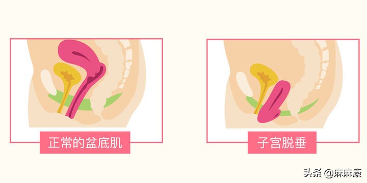 子宫脱垂是什么原因导致的?主要是这5种,千万要注意