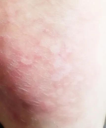 牛皮癣全身红斑大爆发怎么办,全身长满了牛皮癣属于重度吗