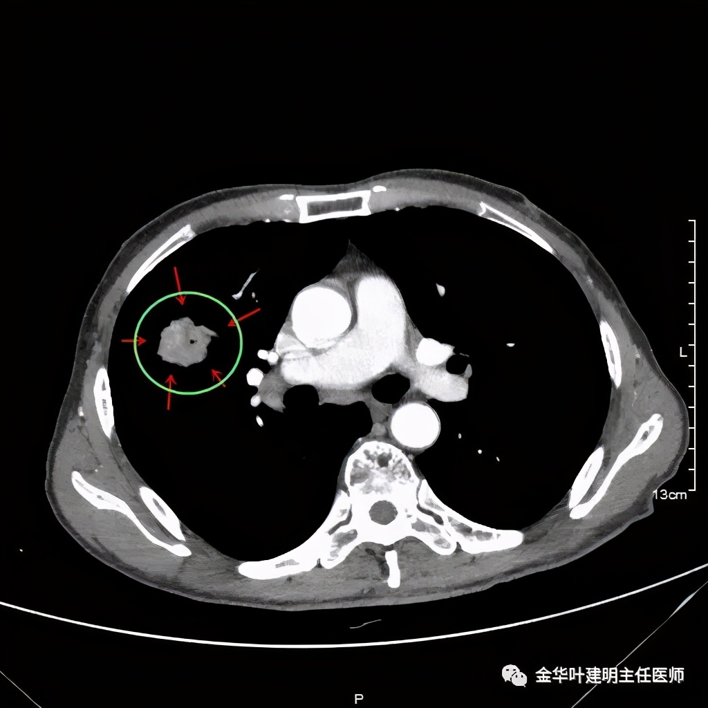 左肺占位被安排穿刺活检是肺癌吗,肺癌肺部穿刺有什么危险