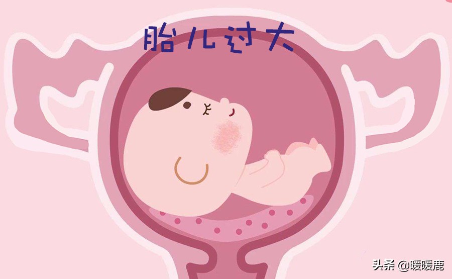 胎儿偏大要做无创吗,妊娠期糖尿病顺产好还是剖腹产好