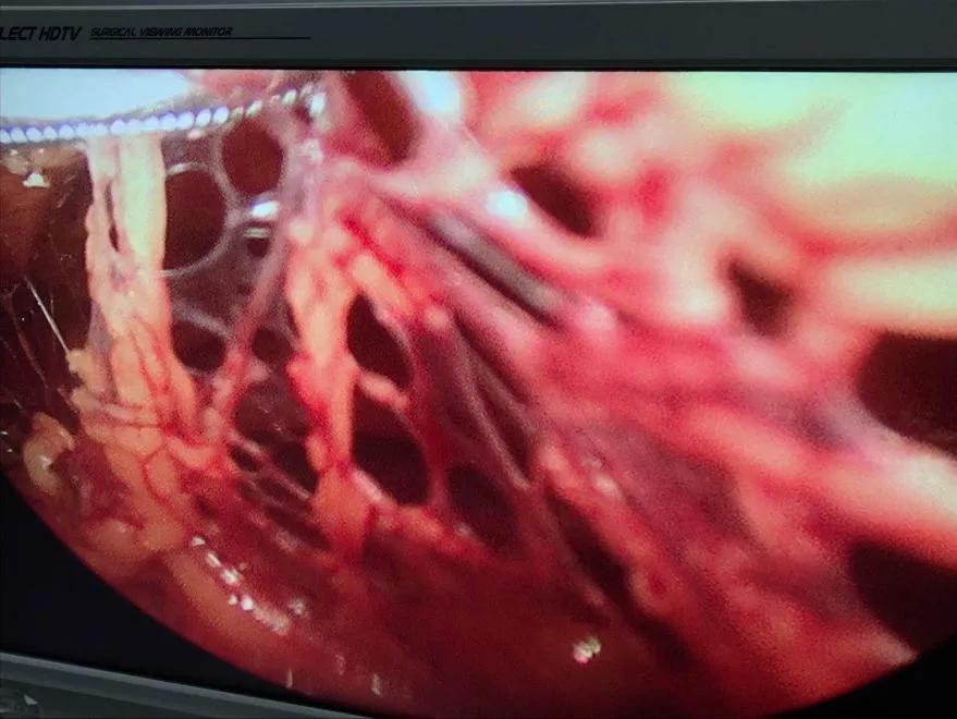 急性盆腔脓肿早期最佳治疗,盆腔脓肿的手术指征