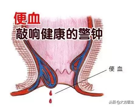 便血是怎么回事大肠癌,便血就是肠癌吗