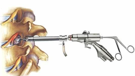 86岁老人腰椎病可以做微创手术吗,台商大叔