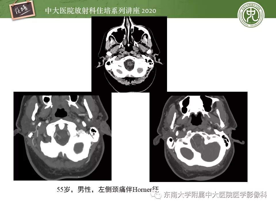 颈动脉夹层的超声表现及漏诊分析,动脉夹层与夹层动脉瘤是一样的吗