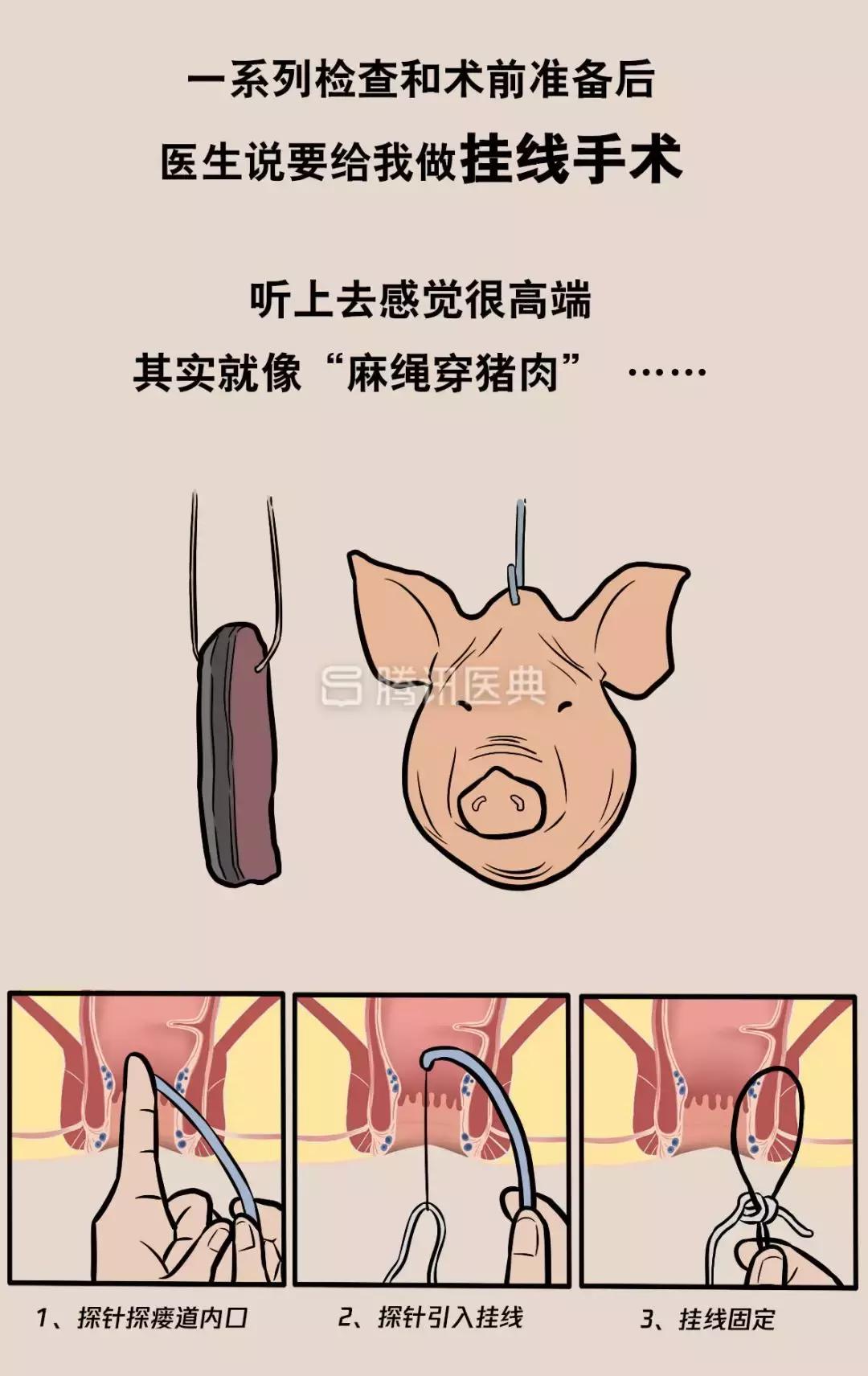 “*菊爆**后”痛到喊妈！真实看病经历泣血奉上，必须保护好菊花