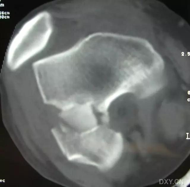 所有骨折都叫什么名字,骨折的名称有哪些