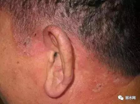 浙江女子一夜之间被毁容,丽水毁容事件