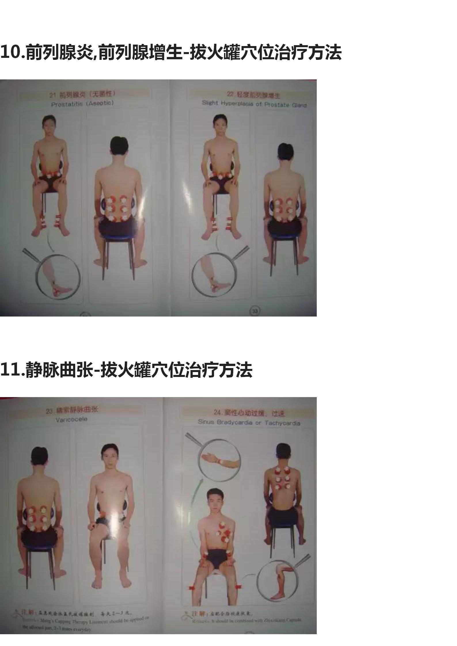 拔罐的手法和穴位图,中医拔罐穴位图片及作用