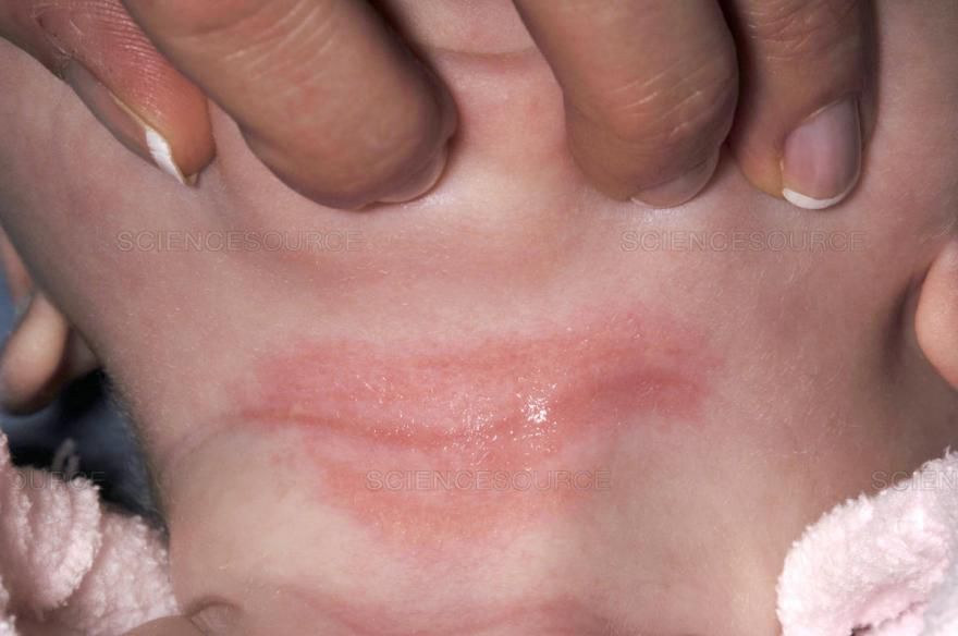 夏季婴儿穿尿不湿有痱子怎么办,宝宝夏季脸上长痱子怎么护理