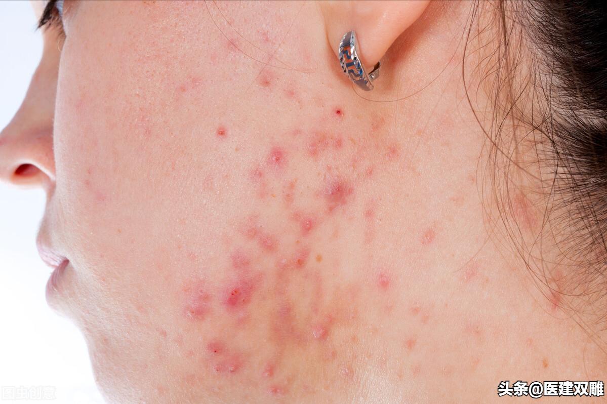 炉甘石洗剂男性慎用,炉甘石洗剂的妙用