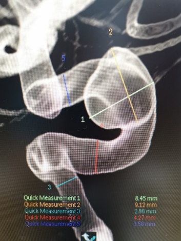 Tubridge®治疗多发性动脉瘤
