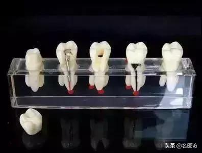 根管治疗戴冠后里面的牙还会烂吗,根管治疗戴冠后一周出现疼痛