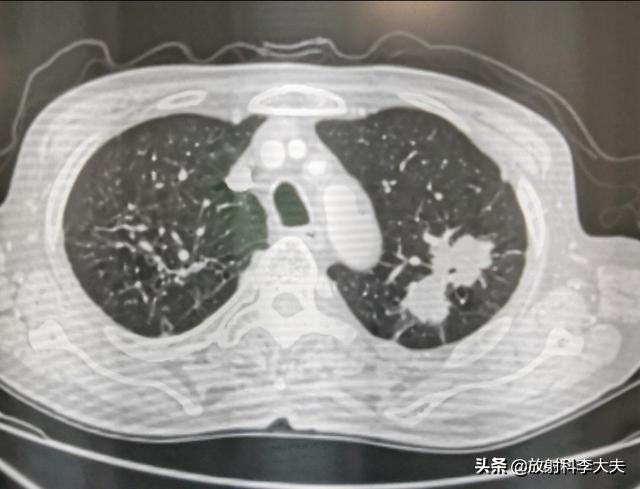 几年前得过肺结核现在胸透有阴影,结核治疗一年了还有胸痛