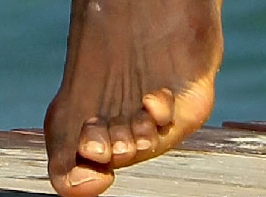 博尔特脚变形,博尔特现在变成了什么