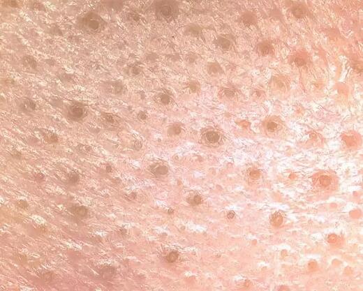 男士如何缩小脸部毛孔,脸部去黑头螨虫缩小毛孔