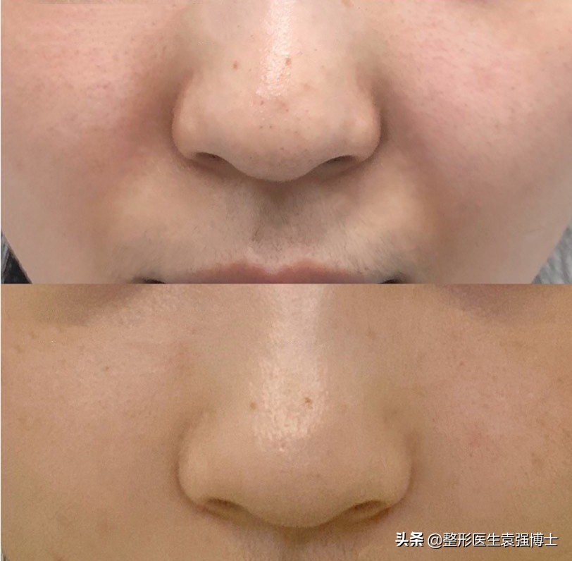 整形法令纹怎么去除最快最有效,整形医院祛法令纹用什么方法好