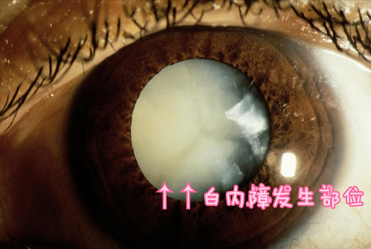 白内障不能治疗了该怎么缓解,得了白内障需要滴眼药水吗