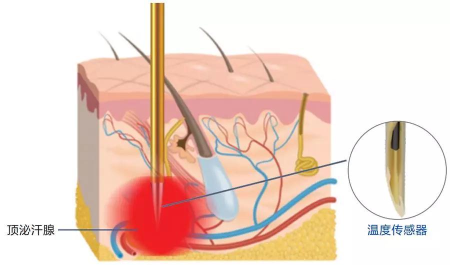 黄金微针射频治疗腋臭原理,微等离子射频无创治疗腋臭