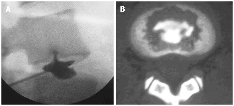 久治不愈腰痛,磁共振没有突出间盘后缘白点,要警惕这病③