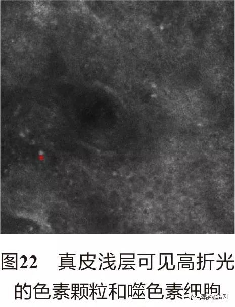 皮肤共聚焦显微镜能查什么,皮肤镜和共聚焦显微镜