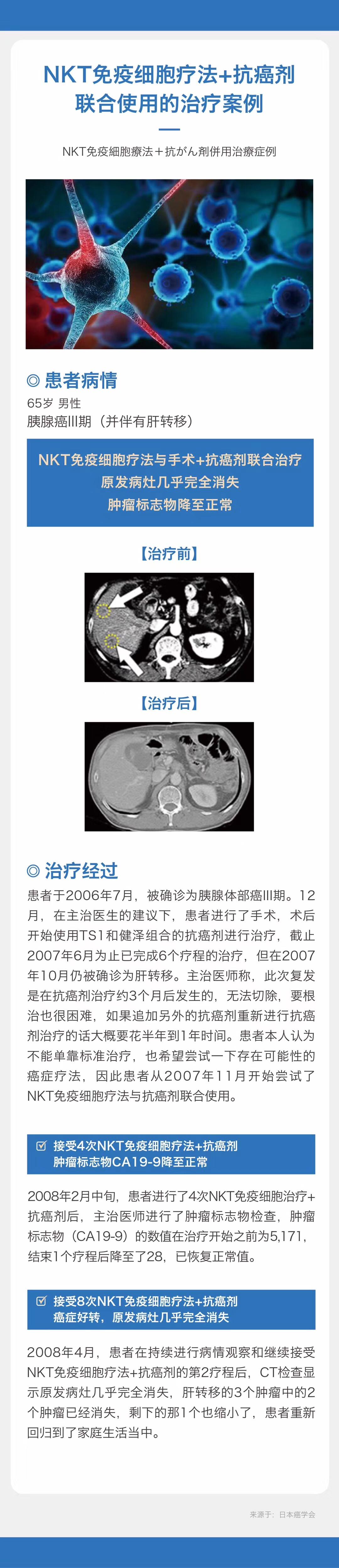 最新科研进展nk免疫细胞治疗癌症,抗癌药物组合物