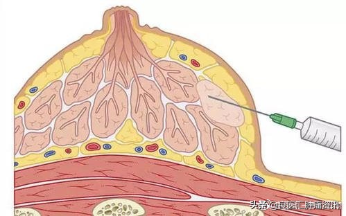 穿刺结束有点疼痛,穿刺抽血后筋痛