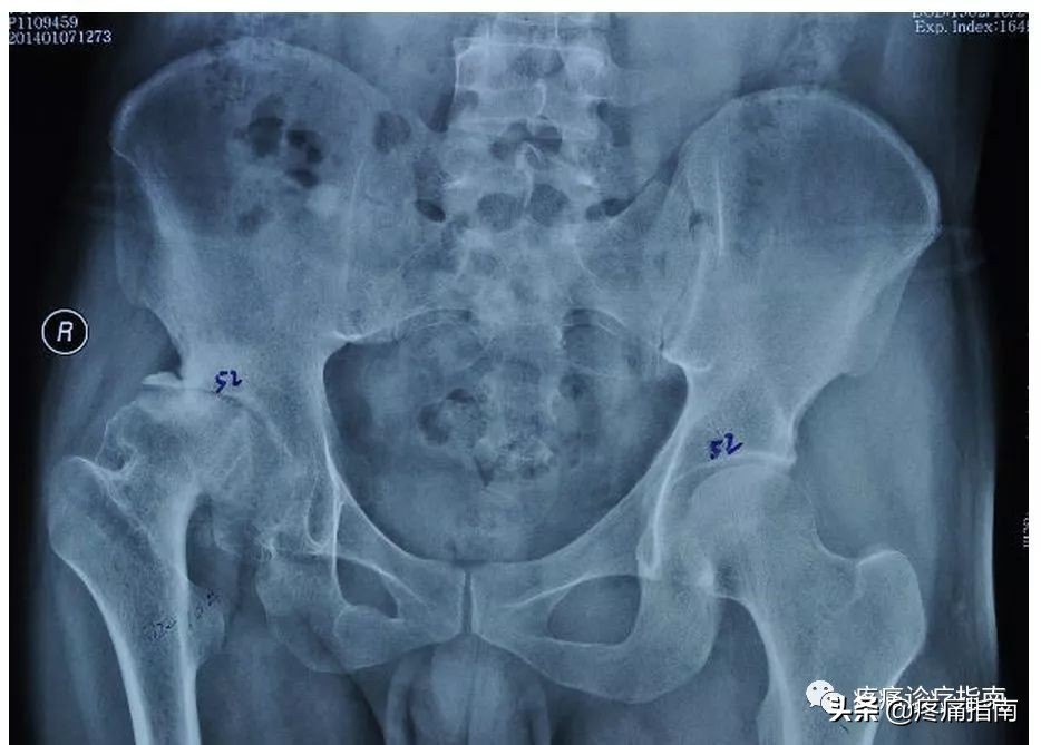 骨性关节炎诊疗指南2019解读,骨性关节炎的护理诊断和措施