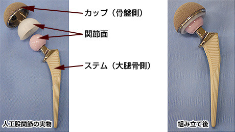 人工关节置换术适应症,关节置换术微创