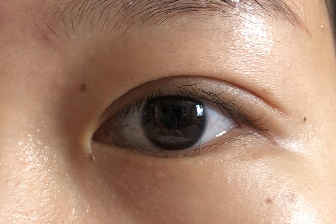 做双眼皮花了15000贵了吗,做个双眼皮手术30000块钱贵吗