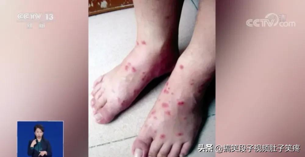 红火蚁咬后有什么处理方法,红火蚁咬伤后有何症状危险吗