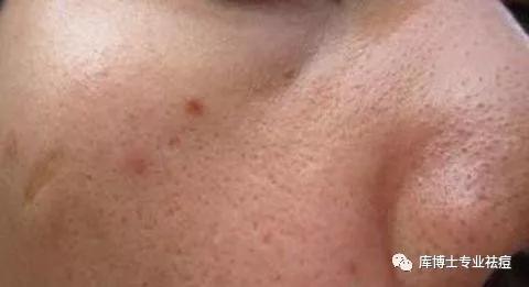 库博士专业祛痘脸部需要多少钱,库博士祛痘效果怎么样