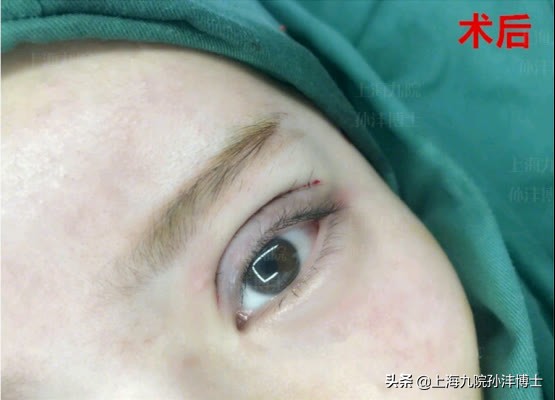 上海九院孙沣博士眼角修复,孙沣修复外眼角