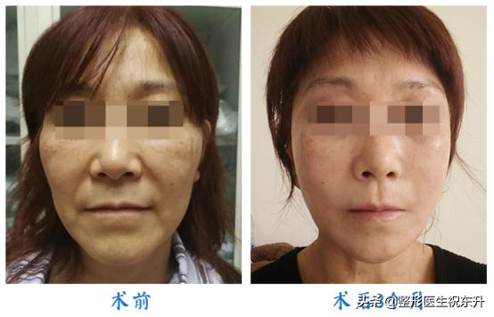 法令纹最快去除的方法医美,法令纹的去除的几种方法医美