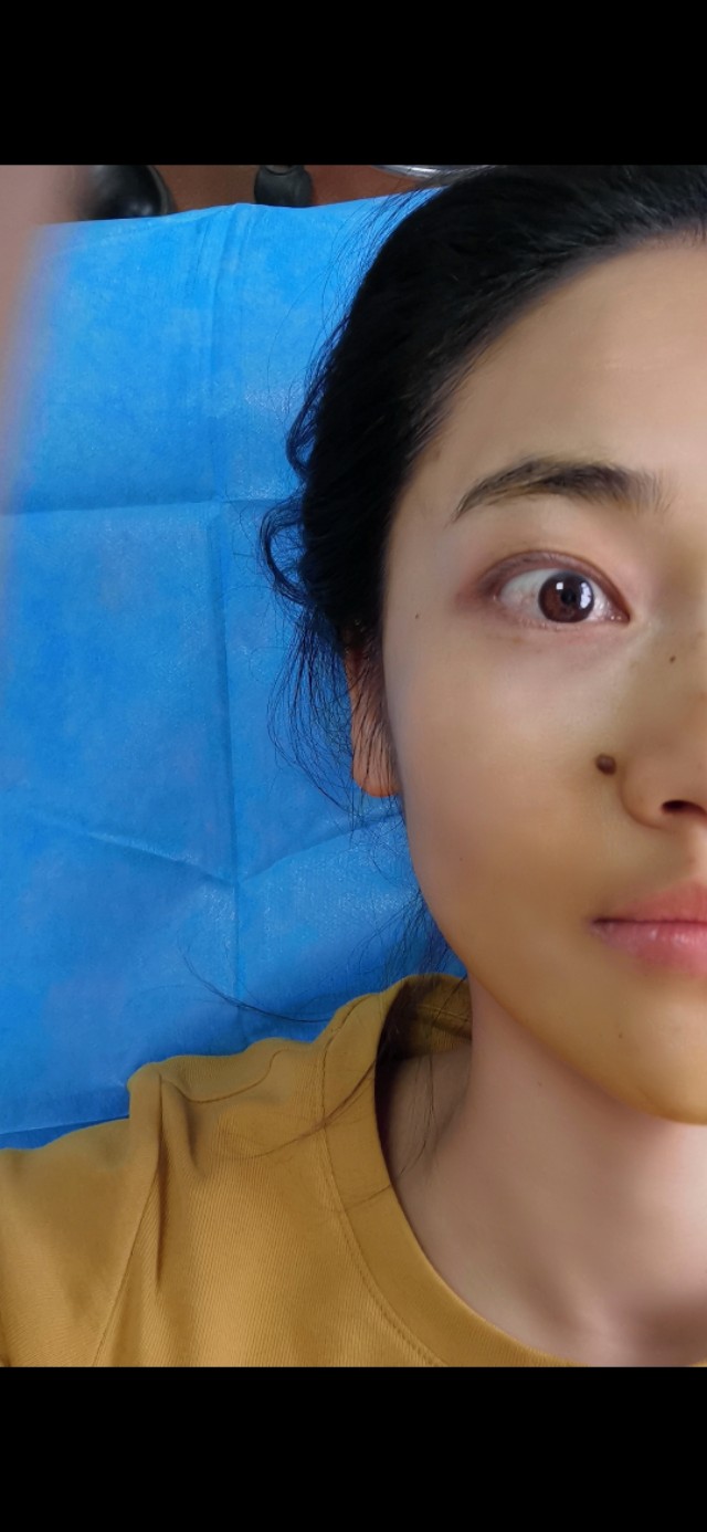 大家都怎么去痣的,祛痣亲身经历100例