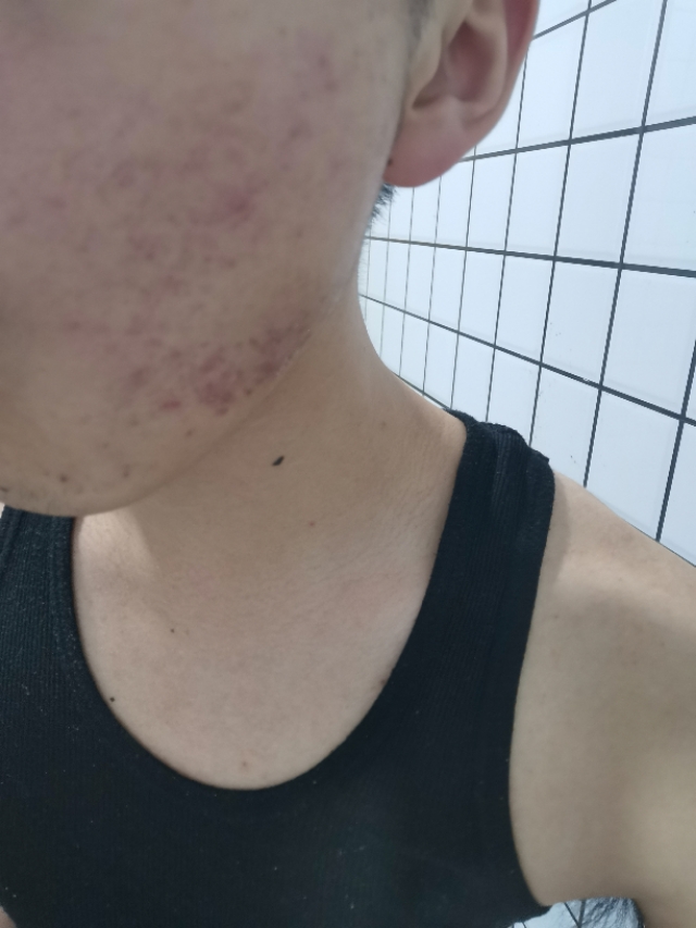 背部痘印黑色素沉淀怎么去除,痘痘痘印怎么去除