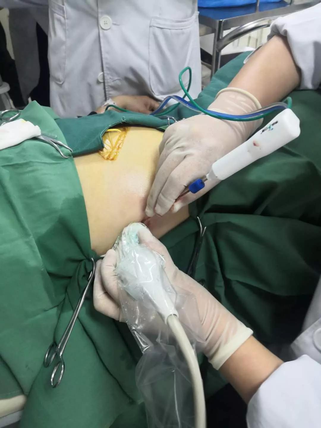 针尖上的艺术超声介入消融术,超声下穿刺针尖显影技巧