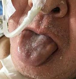 日本男子患罕见血友病舌头发黑肿胀,数度窒息心脏骤停险危及生命