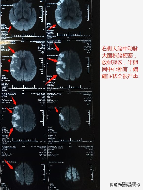 脑梗塞病人拉肚子怎么办,感冒会引起脑梗头晕的加重吗