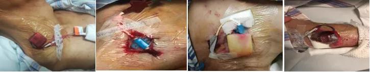 中心静脉导管渗血、渗液处理