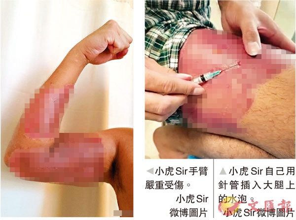 港警每天逐一刺穿伤口上水泡,网友:隔着屏幕都觉得痛