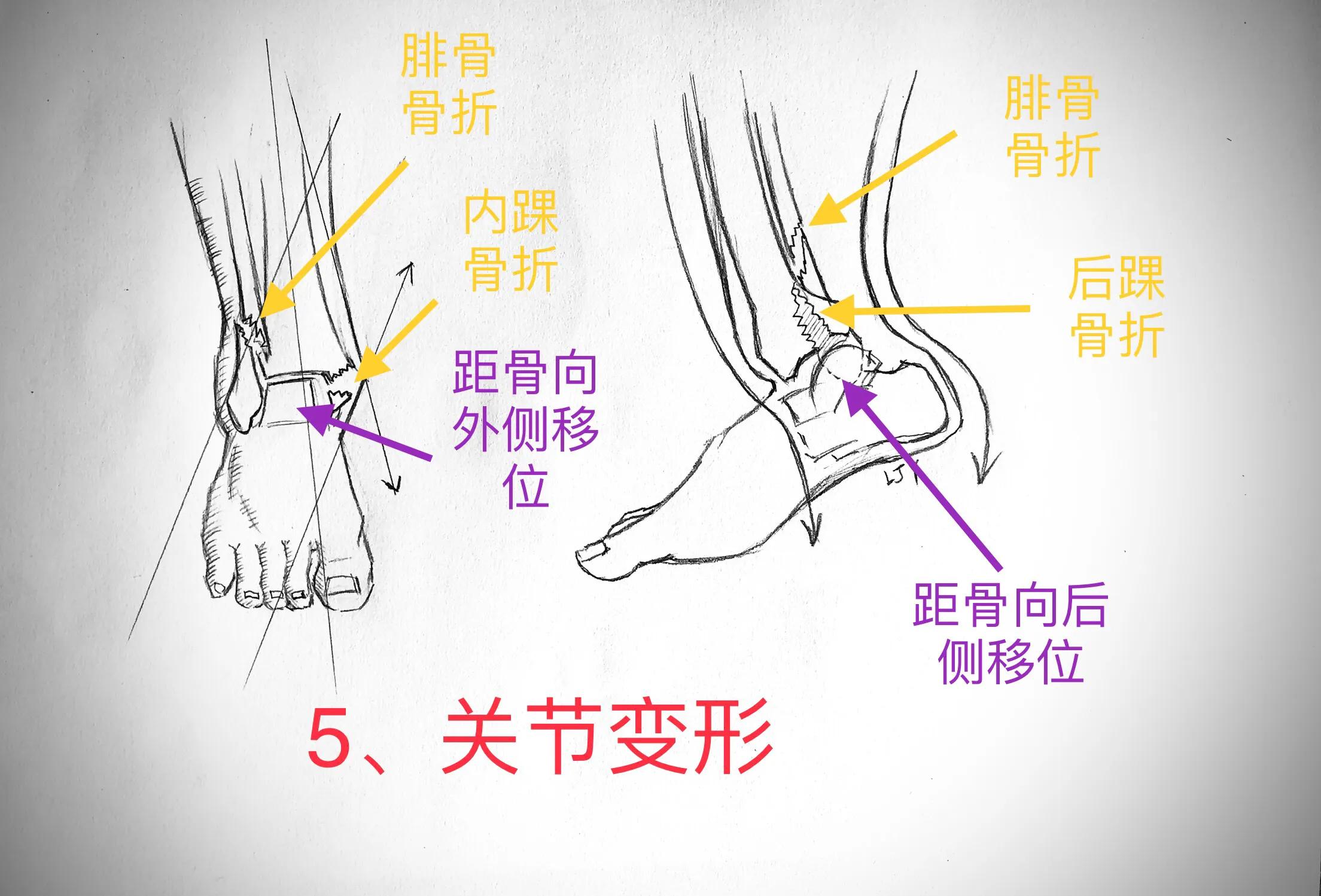 踝关节扭伤后有何表现,踝关节扭伤的自我判断与治疗