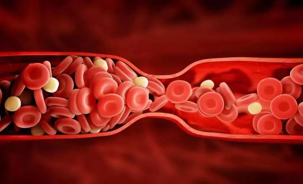 小腿肌间静脉丛血栓起病隐匿,患者通常临床表现为小腿疼痛及肿胀