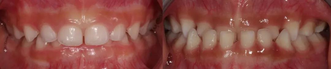 用奶瓶喝水总是呛到怎么办,孩子长期用奶瓶喝水嘴会变形吗